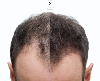 Zagęszczenie włosów / Hair density