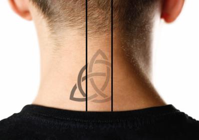 Laserowe usuwanie tatuażu / Tattoo removal