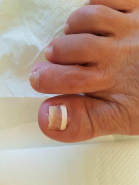 Zakładanie klamer korygujących płytkę paznokcia