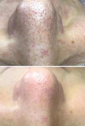 Oczyszczanie wodorowe