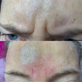 Wypełnianie zmarszczek - kwas hialuronowy