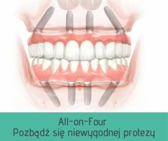 All-on-Four Zęby w jeden dzień na 4 implantach