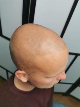 Mikropigmentacja Skóry Głowy