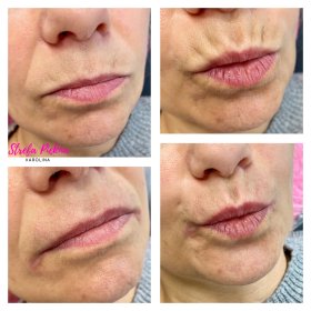 Kwas hialuronowy 1 ml