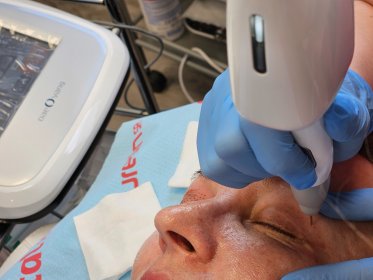 nieinwazyjna korekta powiek Plasmą