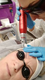 Laserowy peeling węglowy