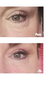 Zmarszczki i przedwczesne oznaki starzenia