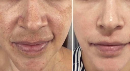 Zaskórniki i wągry