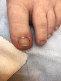 Leczenie i korekcja wrastającego paznokcia