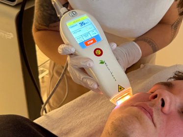 nieablacyjny laser frakcyjny - MultiFrax