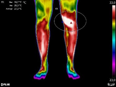 Termografia Medyczna