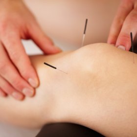 Akupunktura lecznicza - kolejna wizyta