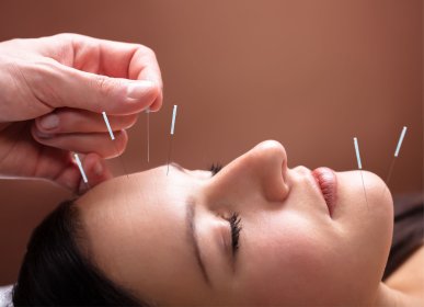 Akupunktura kosmetyczna