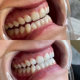 Kosmetyczne wybielanie zębów - 1 osoba