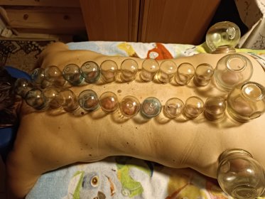 Terapia bańkami ogniowymi, masaż bańką