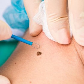 Usunięcie zmian skórnych za pomocą elektrokoagulacji