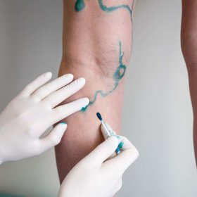 USG Doppler tętniczy lub żylny obu kończyn