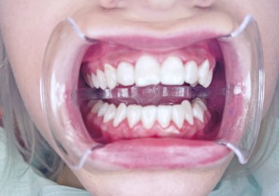 skaling zębów