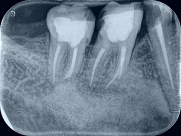 kanałowe leczenie zęba