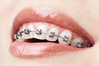 Bezpłatna konsultacja ortodontyczna