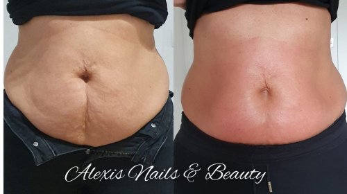 wyszczuplenie w talii  lub innych części ciała