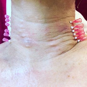 Nici rewitalizujące PDO i PLLA