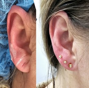Bezbolesne przekłuwanie uszu