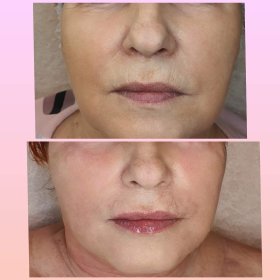 Wolumetria kątów żuchwy 1ml