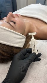 Peeling chemiczny z kwasem ferulowym