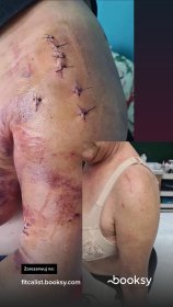 Fizjoterapia z wykorzystaniem radiofrekwencji.