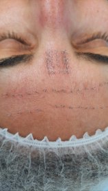 Akupunktura Kosmetologiczna Pinezkowanie