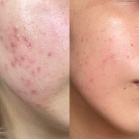 🔹 Oczyszczanie Skóry z Nawilżeniem i Maską LED Ustroń