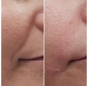 Stymulatory tkankowe / biorewitalizacja