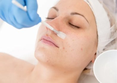 Peeling kwasem azelinowym