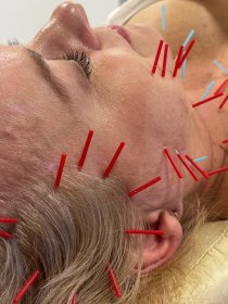 Akupunktura kosmetyczna