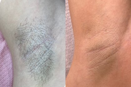 Depilacja laserowa dla nowych klientów rabat 100 zł!