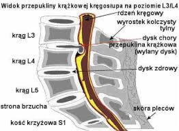 Ilustracja przekroju kręgosłupa lędźwiowego z zaznaczoną przepukliną krążkową na poziomie L3/L4, widoczne kręgi, dyski (zdrowy i chory), rdzeń kręgowy i skóra pleców.