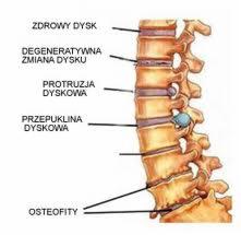 Ilustracja przekroju kręgosłupa z zaznaczonymi zmianami degeneracyjnymi, protruzją dyskową, przepukliną i osteofitami. Widoczne opisy w języku polskim.