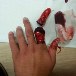 Żyrardowskie Powiatowe WOPR - Dramatyczne zdjęcie: zakrwawiony palec po amputacji, obok opatrunek i odcięty fragment palca na serwetce. Realistyczny widok z bliska.