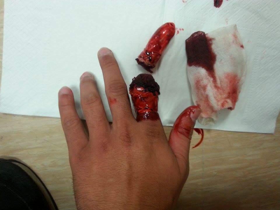 Dramatyczne zdjęcie: zakrwawiony palec po amputacji, obok opatrunek i odcięty fragment palca na serwetce. Realistyczny widok z bliska.