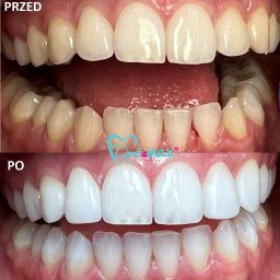 Efekt wybielania zębów w Centrum Stomatologii Dentamax.