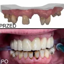 Proteza na implantach