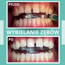 Zdjęcie porównawcze zębów przed i po zabiegu wybielania, widoczne nakładki z żelem, zęby górne i dolne, efekt rozjaśnienia odcienia szkliwa.