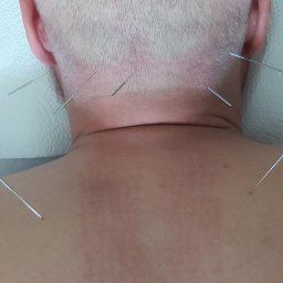 Wsparcie akupunkturą  klawiterapią w leczeniu bóli potylicznych głowy 