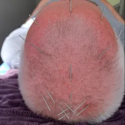 Górny widok głowy pacjenta z kilkunastoma igłami do akupunktury umieszczonymi w skórze, leżącego na fioletowym ręczniku.