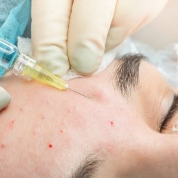 Gabinet Kosmetyczny oraz Studio Wizażu i Charakteryzacji Estetica - Mezoterapia igłowa