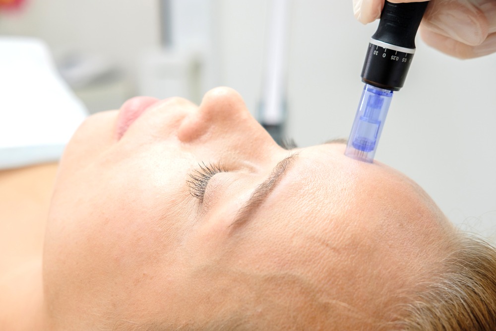 Dermapen, mezoterapia mikroigłowa skóry, mikronakłuwanie skóry
