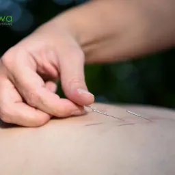 akupunktura