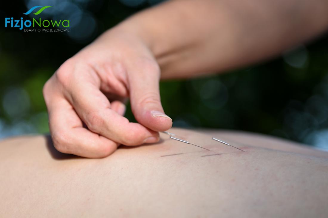 akupunktura