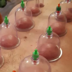 Bańki próżniowe z zielonymi i pomarańczowymi zaworami na plecach pacjenta, widoczne zaczerwienienia skóry pod bańkami.